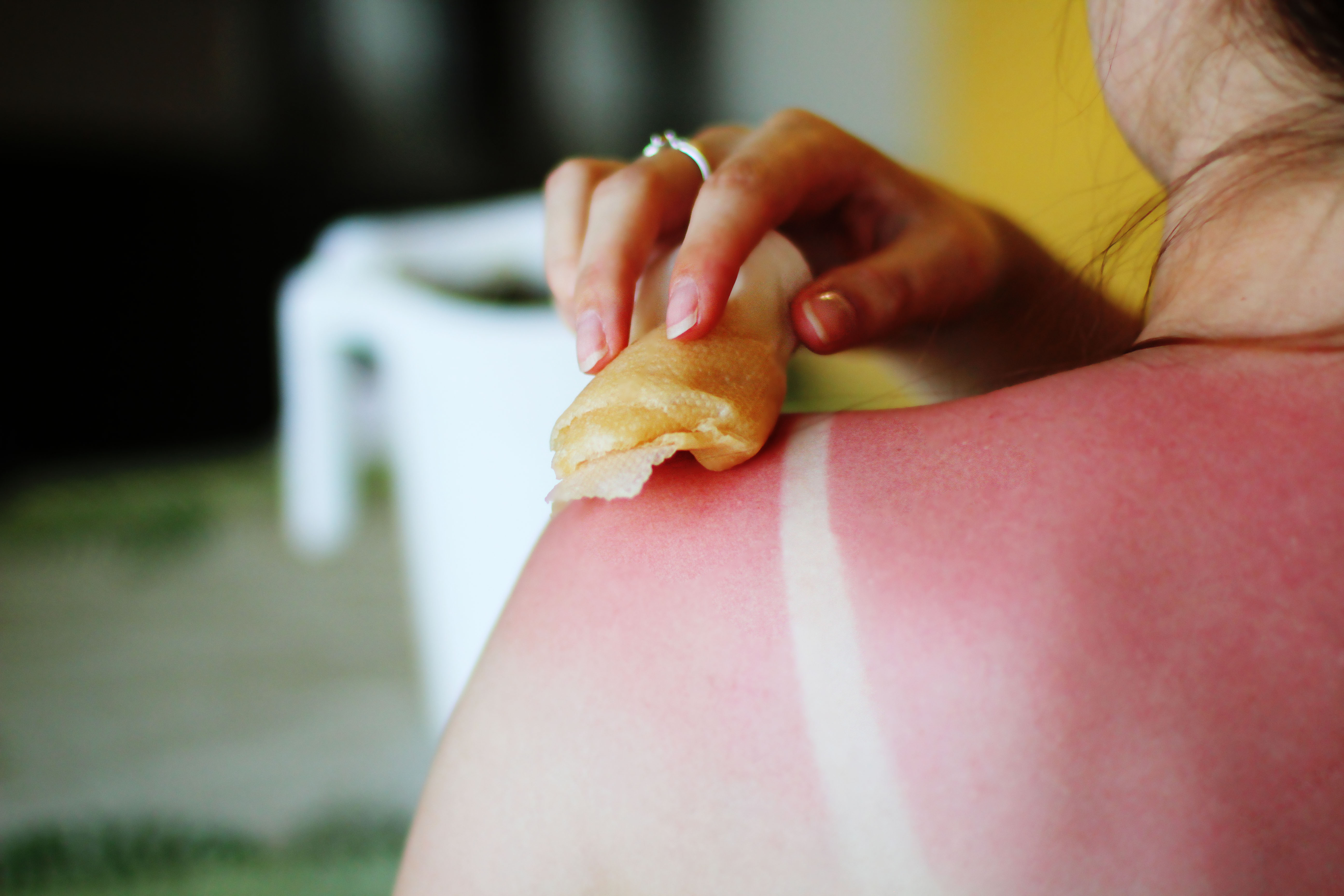 A woman treating sunburn | Source: Getty Images